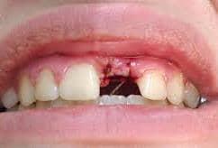 removed tooth 